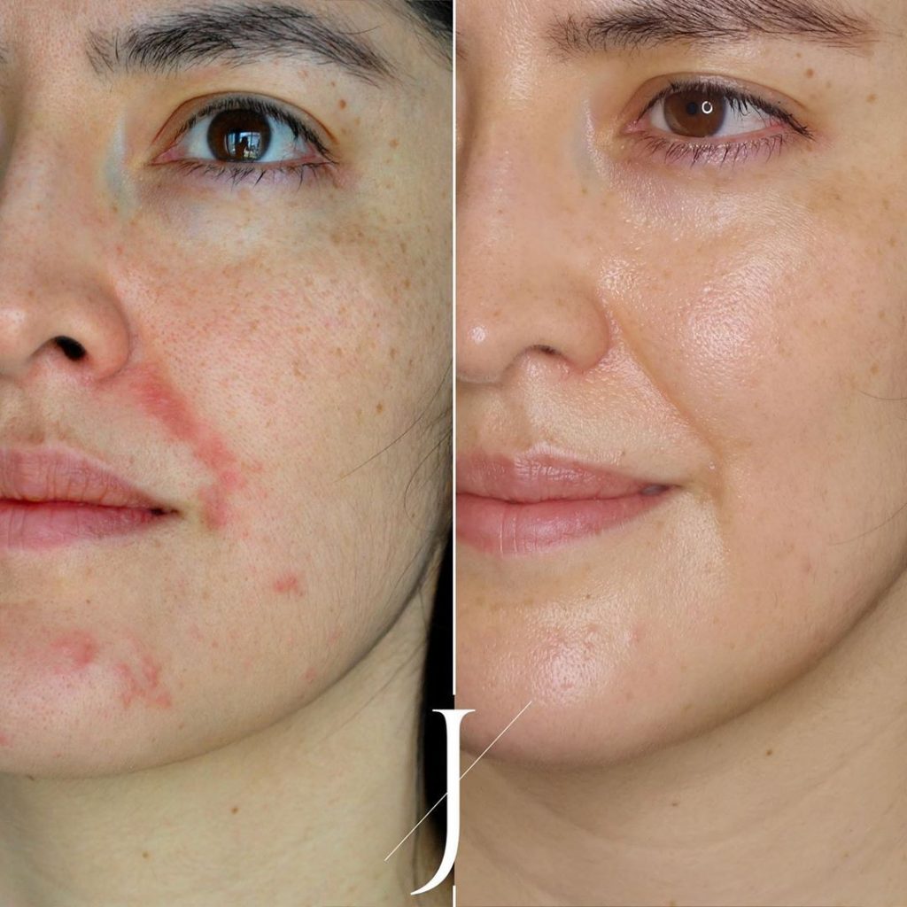 Dermatitis Perioral - Clínica Alejandría