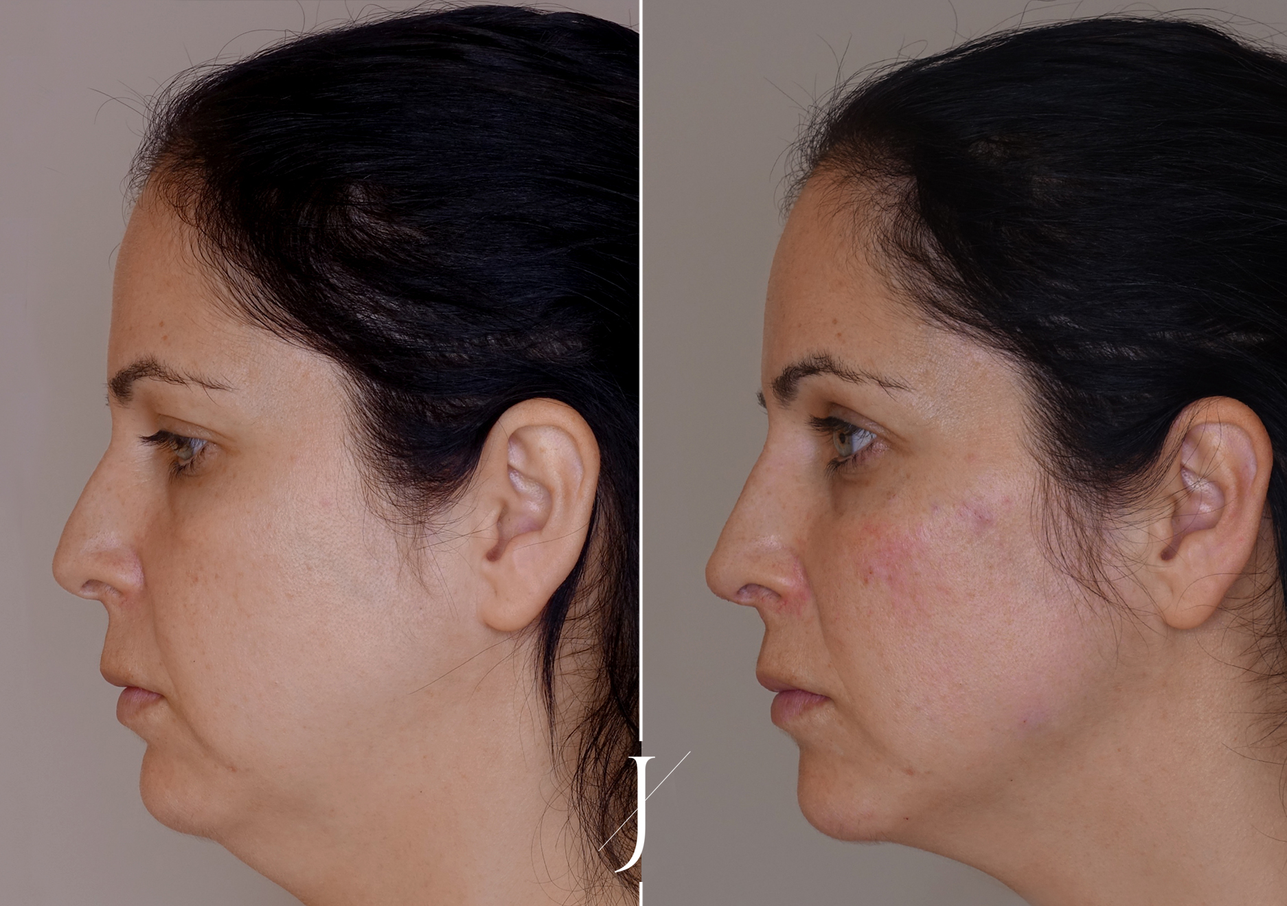 Tratamiento estética neutralización facial caso clínico antes y después