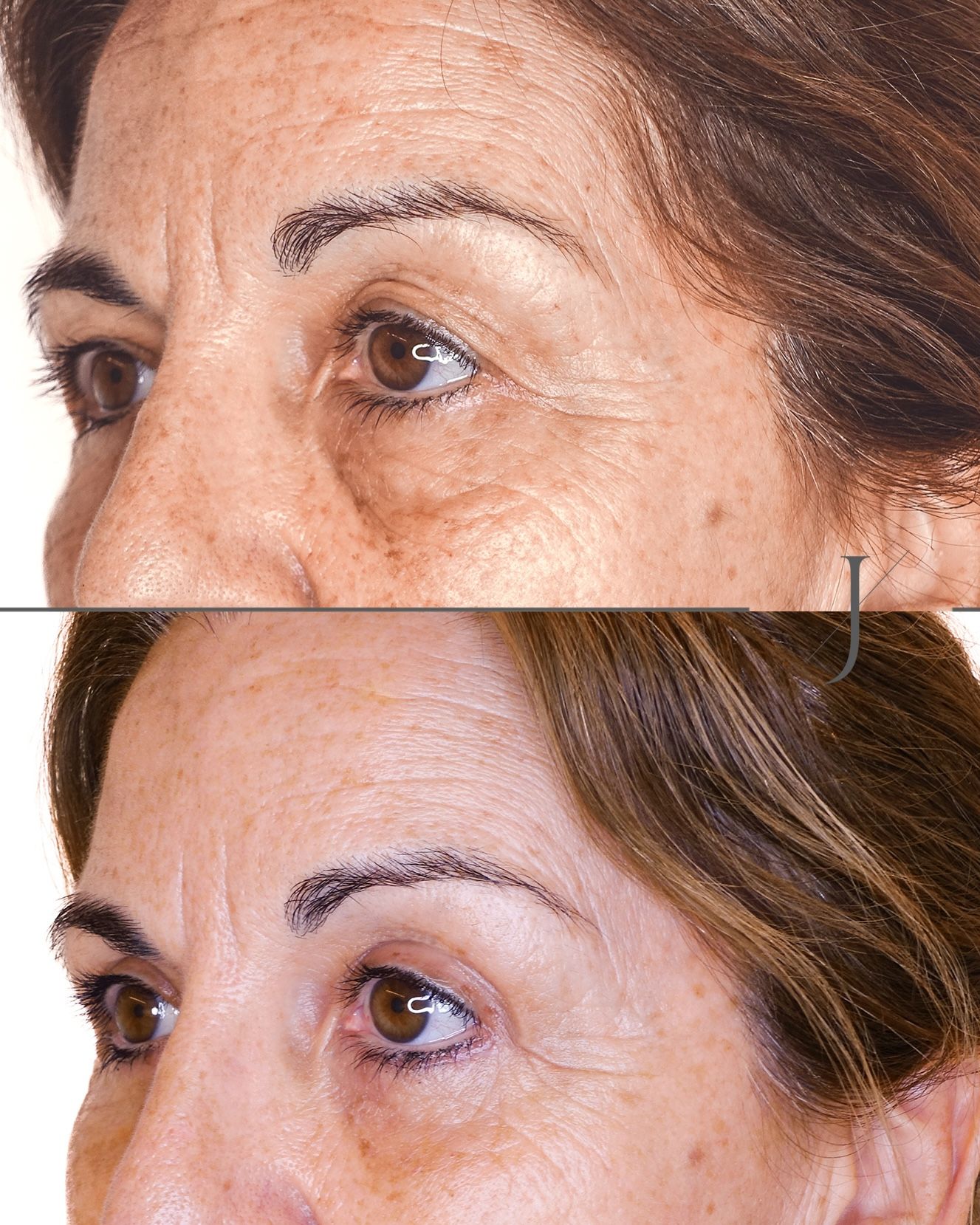 Antes y después blefaroplastia en Clínica Alejandría