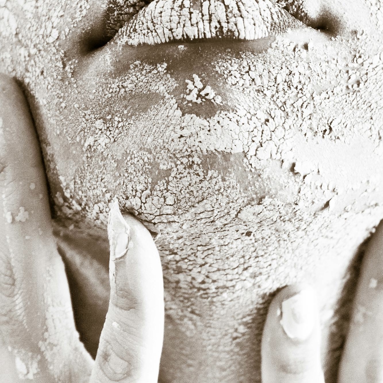 Dermatitis.atopica.clinica.alejandria.valencia